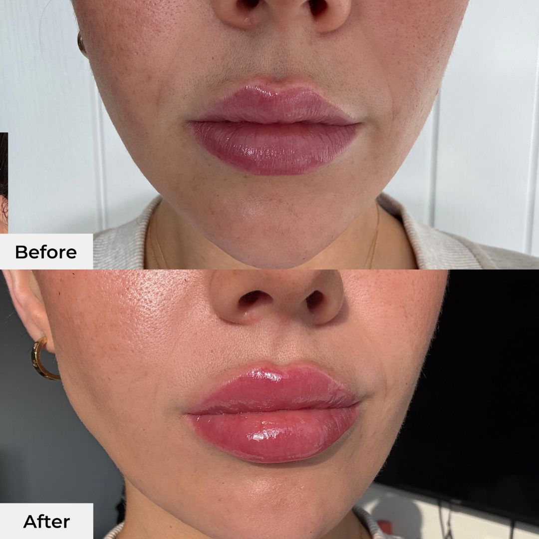 Instant Lip Plumper